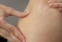 Distinguishing Between Stretch Marks Cellulite